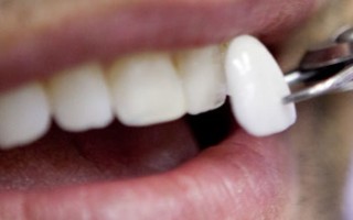 carillas-dentales