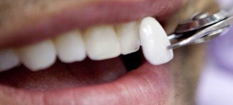 carillas-dentales