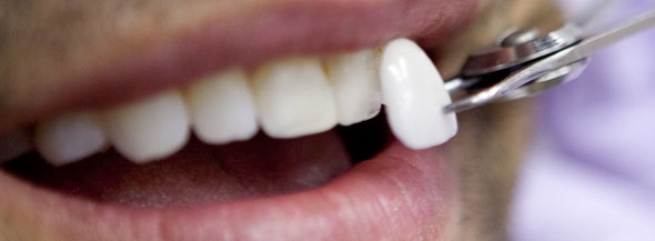 carillas-dentales